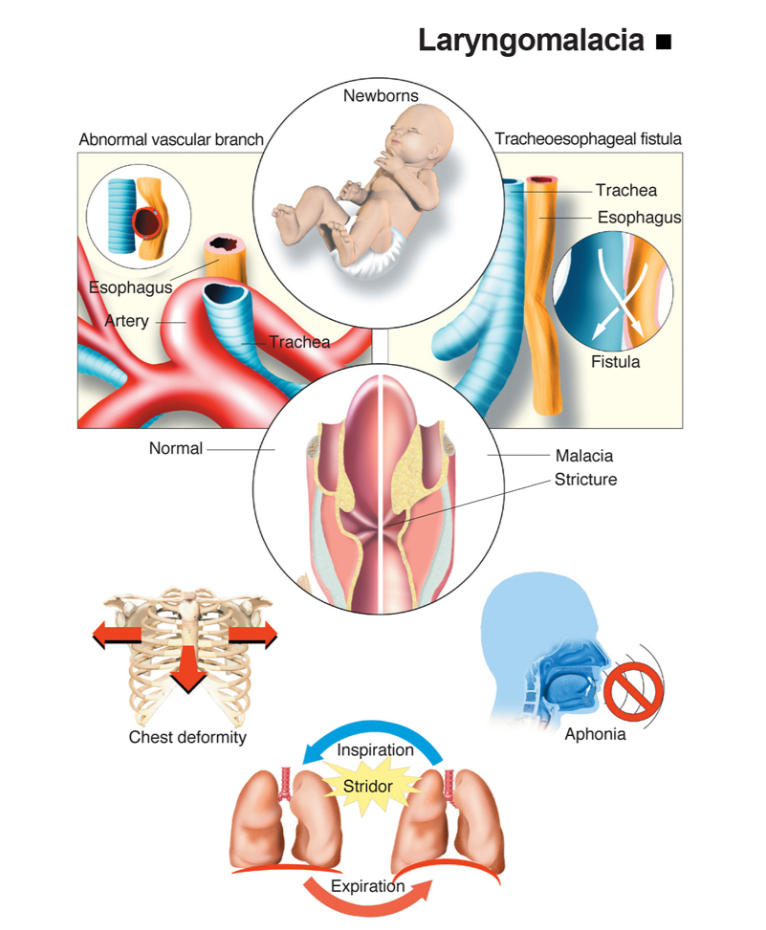 Infografis Laryngomalacia